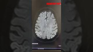 Mri Show Right parietal lobe Diffusion /ADC restriction S/o infarction @Radiologydept