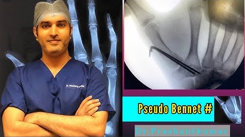 Pseudo Bennett Fracture Reduction Technique & K-Wire Fixation | 1st Metacarpal #|Thumb Fracture 🔥🔥