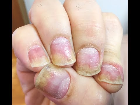 Video: Hilse Tai Psoriasis: Opi Merkit