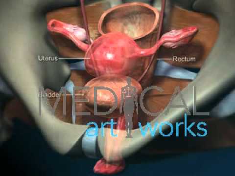 Medical Animation | Vaginal Prolapse - Cystocele (fallen bladder)
