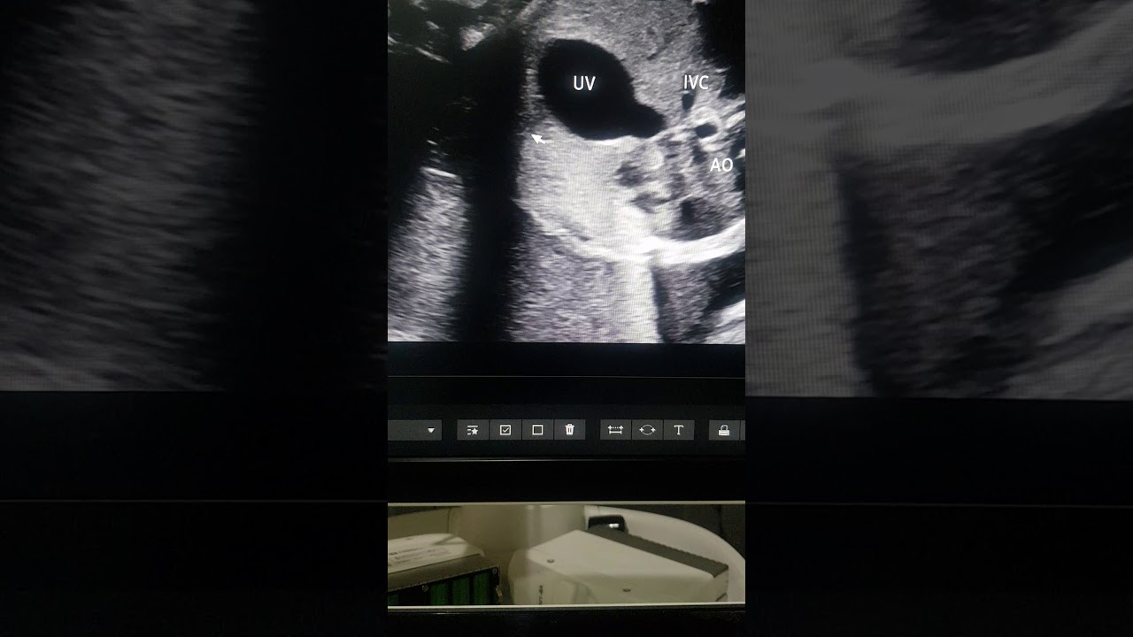 Варикозное расширение пупочной вены плода. Доктор Прадип Шринивасан, серия статей REFER SERIES, r...