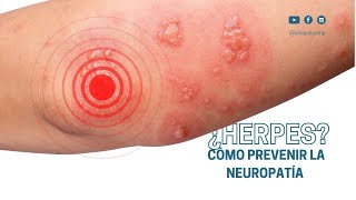 How to prevent herpes neuropathy?