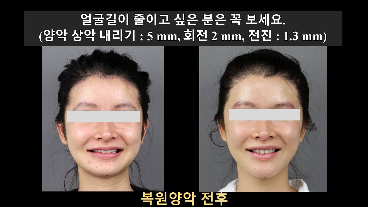 얼굴길이 줄이고 싶은 분은 꼭 보세요(양악상악내리기 5 mm,회전 2 mm) If you want to reduce your facial length, don’t miss this
