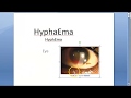 Ophthalmology 222 a  HyphAema Blood in Anterior Chamber of Eye