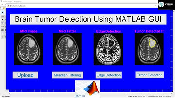 Brain Tumor Detection Using MATLAB GUI with Source Code [Image Processing 2022]