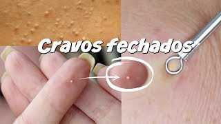 COMO EXTRAIR CRAVOS FECHADOS - Bruna Harmel