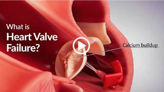 What is Heart Valve Failure (HVF)?