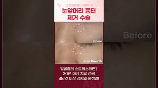 얼굴 흉터치료 잘하는 곳 전후 안성열성형외과 #shorts