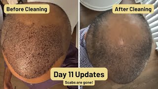 11 Day Update | 5200 grafts from Vera Clinic in Istanbul Turkey