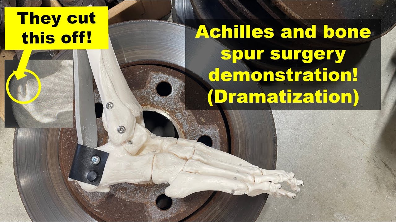 DIY Heel Spur Removal in My Garage