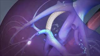 VIATORR - GORE MEDICAL