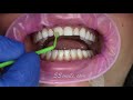 prepless porcelain dental veneers cosmetic dentistry before and after