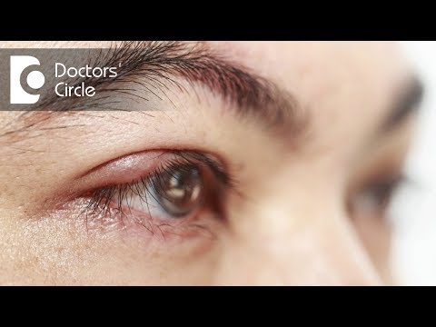 Do swollen, itchy & burning eyes indicates Blepharitis? - Dr. Sunita Rana Agarwal