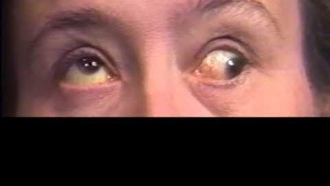 Aberrant Regeneration of the Third and Sixth Nerves