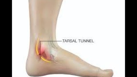 CPT code for Release - simplify medical coding