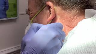 Incision and drainage of inflamed epidermoid cyst