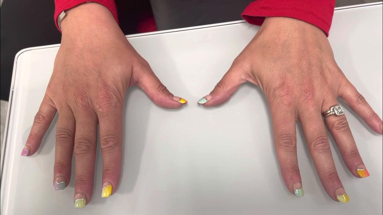 Thumb CMC joint replacement YouTube