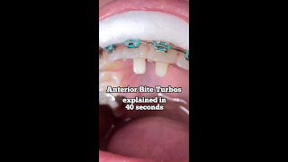 Anterior Bite Turbos - Tooth Time Family Dentistry