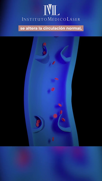 ¿Por qué aparecen las varices? Te lo explica un Cirujano Vascular