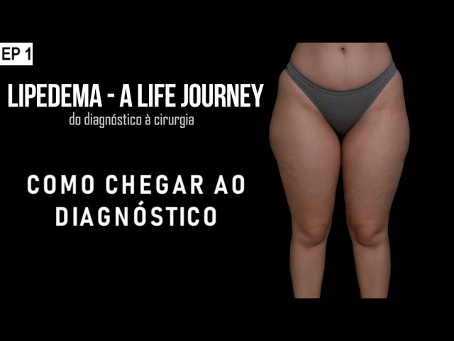 COMO CHEGAR AO DIAGNÓSTICO DE LIPEDEMA, EP 1