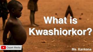 What is Kwashiorkor disease | Medical Science | General Medicine