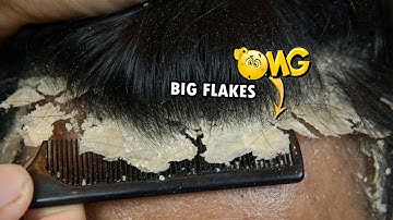 OMG!! Dandruff Scratching ASMR #843