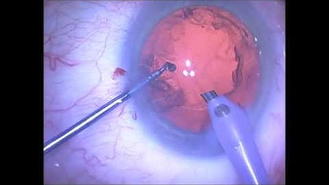 Phacoemulsification for residents