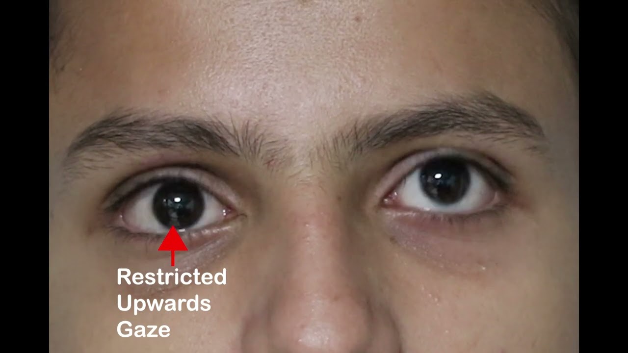 Restriction of Right Eye movement following trauma