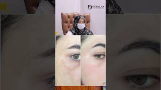 skincare skin melasma dermlax