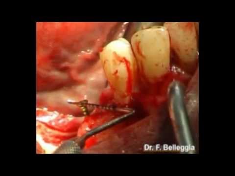 Vertical GBR with Titanium Reinforced d-PTFE Membrane