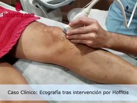 fisioterapia laser Ecografía tras intervención por hoffitis, caso clínico