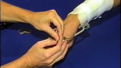 II - Dynamic Extension Splint for the Wrist Part 2