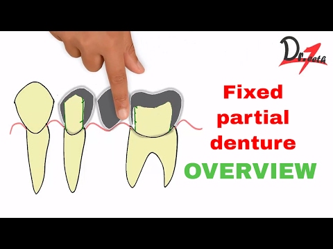 Fixed partial denture : Overview (ENGLISH)