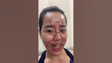 Kỹ thuật tiêm rãnh cười FILLER HA làm đầy rãnh mũi má quá dễ I Dr Hoa Lee