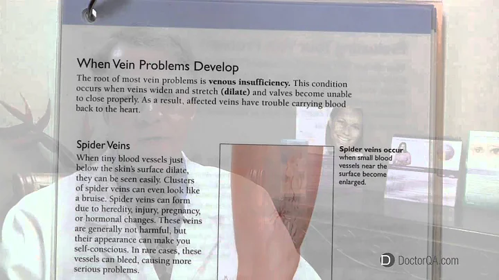 When should I be checked for venous disease? - Dr....