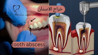 خراج الاسنان /اسباب خراج الاسنان /علاج خراج الاسنان