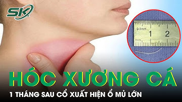 Hóc Xương Cá, 1 Tháng Sau Dị Vật Tạo Thành Ổ Mủ Lớn | SKĐS