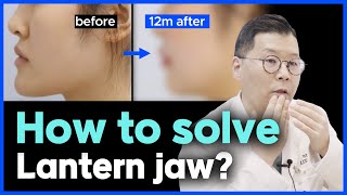 [EN] (Lantern jaw) How to solve the lantern jaw? l Korean lantern jaw surgery case review!