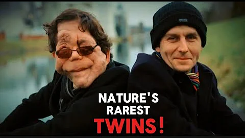 👯‍♂️ 10 of the Rarest Twins Ever Born – Unbelievable Genetic Miracles! 🤯