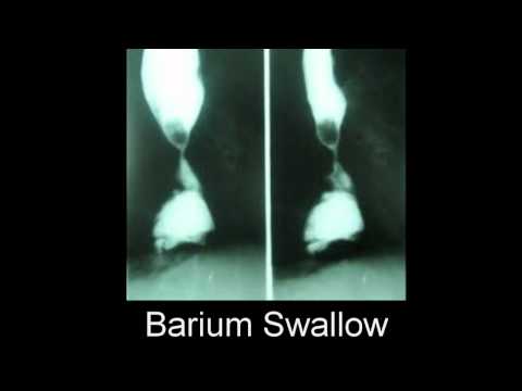 TroubleTroubleSwallowingTroubleTroubleSwallowing? Join UCLA gastroenterologist Craig Gluckman, MD, f. 