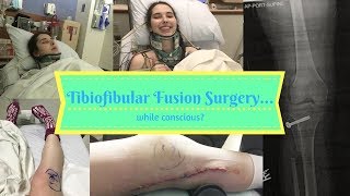 Vlogging with EDS: I WAS AWAKE THE ENTIRE SURGERY!  Tibiofibular Fusion | Week 74