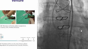 Case 48: Manual of CTO Interventions - Left main and circumflex CTO