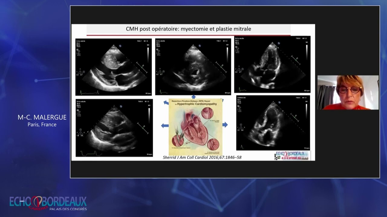 Une alcoolisation septale de cardiomyopathie hypertrophique
