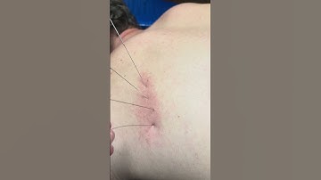 Dry needling teres minor