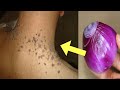 SKIN TAGS REMOVER