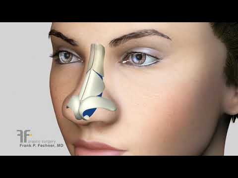 MÔ PHỎNG QUÁ TRÌNH THU NHỎ ĐẦU MŨI