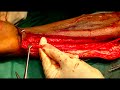 Pan brachial plexus - YouTube
