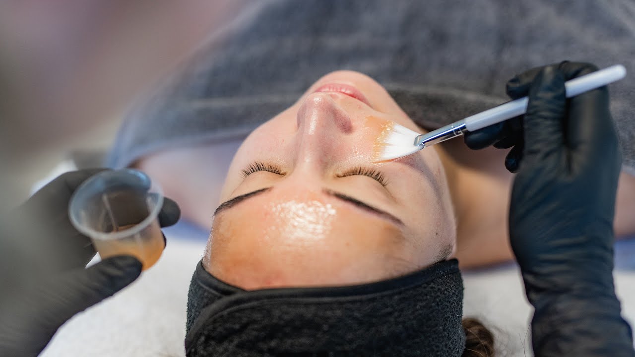 Medische Peeling || YESS Huidtherapie Groenlo