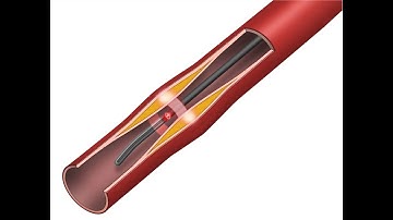 Nirtek NIRAF Guidewire Animation