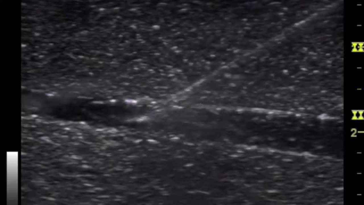 Ultrasound Guided Needle Placement (Demonstration) YouTube
